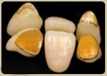 Металлокерамика на золото-платиновом сплаве передних и жевательных зубов.
