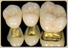 Металлокерамика на золото-платиновом сплаве передних и жевательных зубов.